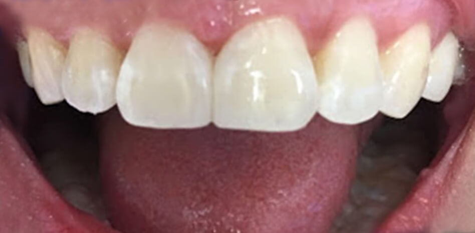 Bioclear Treatment After