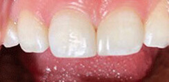 Bioclear Treatment After