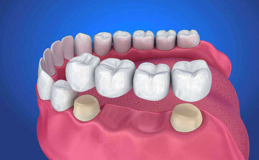 Dental Crowns & Bridges North York | Lu Dental North York