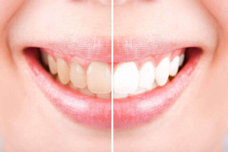 Teeth Whitening North York | Lu Dental North York