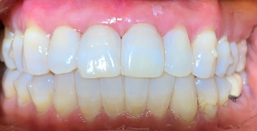 Bioclear after Invisalign After