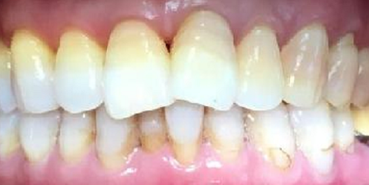 Bioclear after Invisalign Before